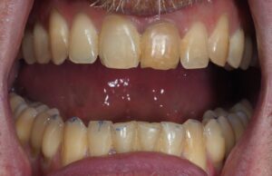 Photo de la Bouche lors de l'évaluation d'occlusodontie